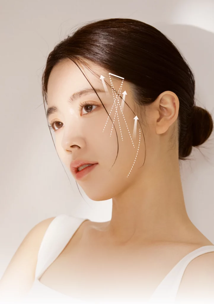 실 리프팅 고정 방향.