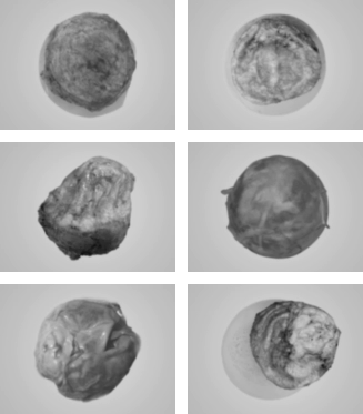 Real thickened capsules removed from breast after Korean breast revision surgery.