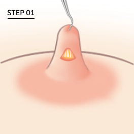 Make small incision for inverted nipple Korean nipple reduction surgery.