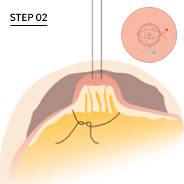 Case 1 inverted nipple correction method.