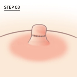 How inverted nipples are sutured for Korean nipple reduction.