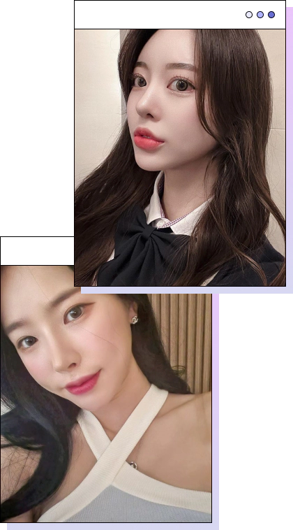 Woman with a slimmer face after platysmaplasty for double chin.