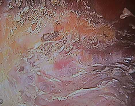 Endoscopic view of a dry pocket made during Korean breast augmentation.