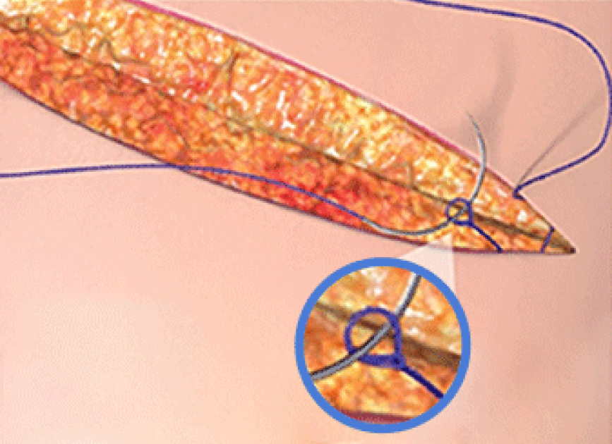 겨드랑이 내시경 절개 부위의 봉합사.