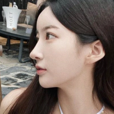 Slimmer jawline after platysmaplasty (muscle tying) for double chin.