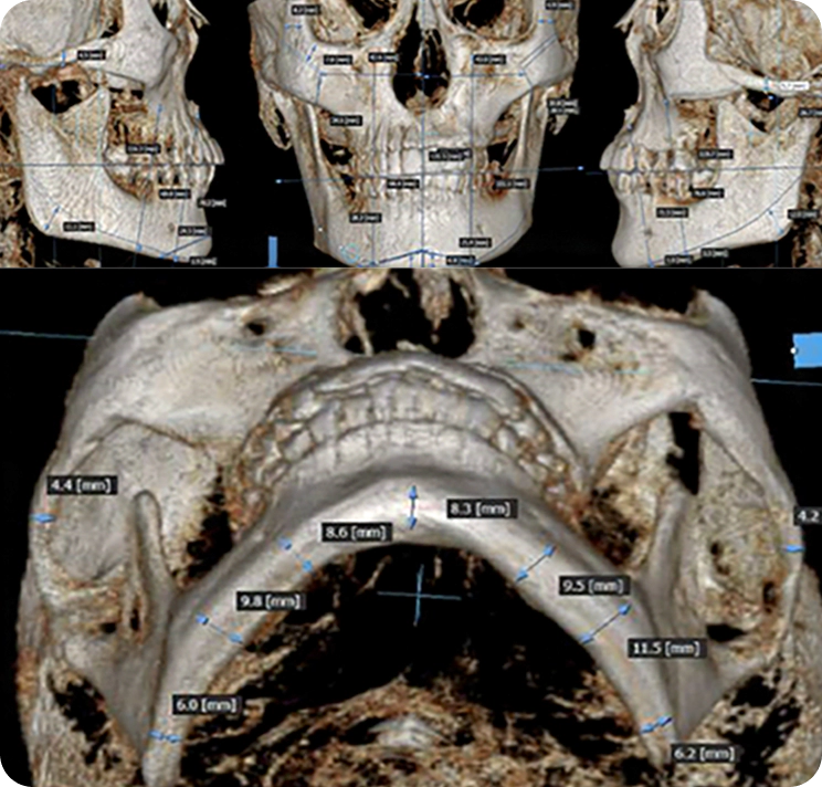 Bone genioplasty CT image.