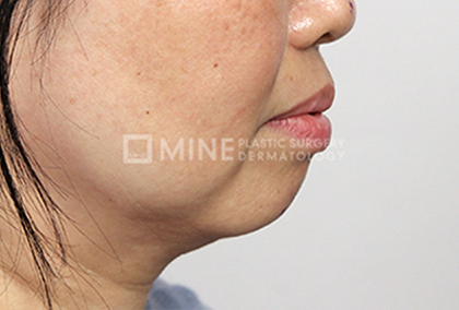 Before Genioplasty 3.