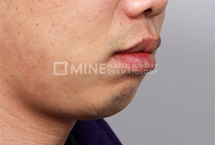 Before Genioplasty 2.