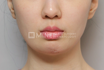 Before Genioplasty 1.