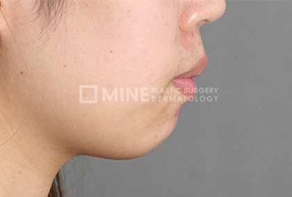 Before Genioplasty 5.