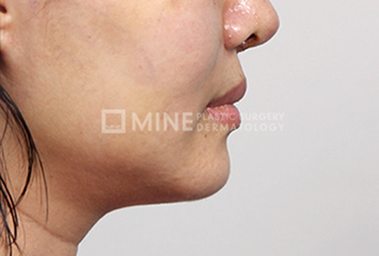 Genioplasty results 4.