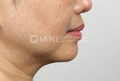 Genioplasty results 3.