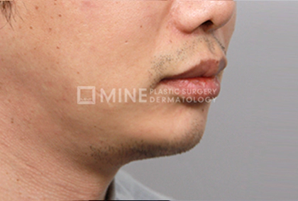 Genioplasty results 2.