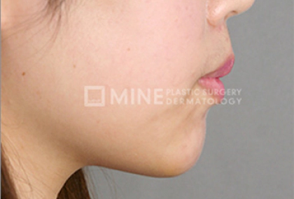 Genioplasty results 5.
