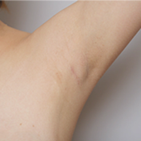 겨드랑이 절개로 가슴 내시경을 사용해 가슴 재수술을 받았으나 살짝 붉은 흉터만 있다.