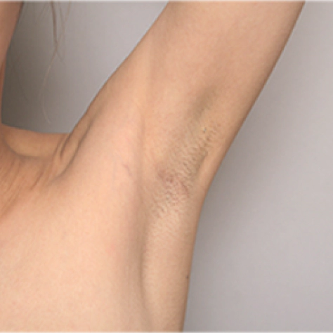 가슴 재수술을 겨드랑이 내시경으로 받은 후의 여성.