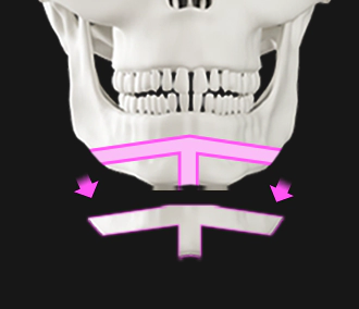 T shape genioplasty bone reduction.