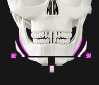 T shape osteotomy genioplsaty surgery for wide chin and wide jaw.