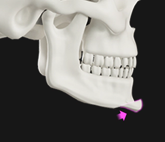 Chin extension method for genioplsaty.