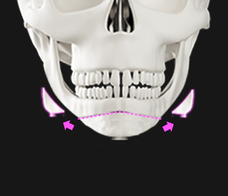 Smaller bone structure after genioplasty.