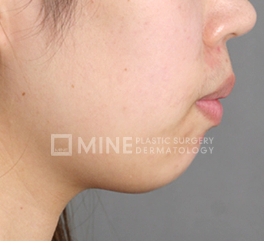 Receding chin before genioplasty.