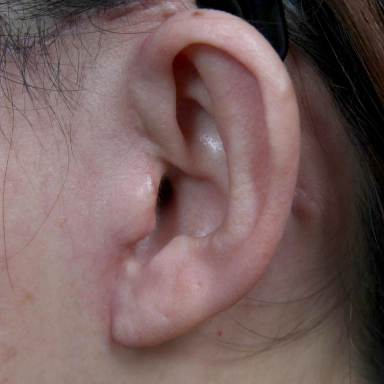 Korean facelift scar 1 month after surgery.