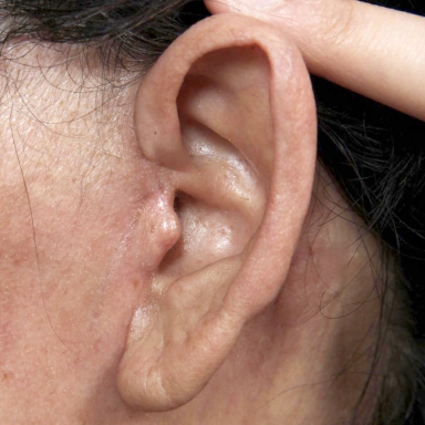 Korean facelift scar barely visible 3 months after surgery.