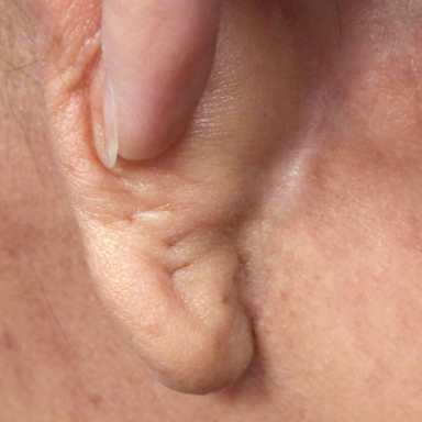 Korean facelift scar behind ear 3 months after surgery.