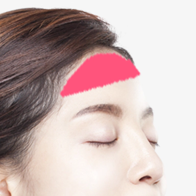 Forehead implant contouring surgery.
