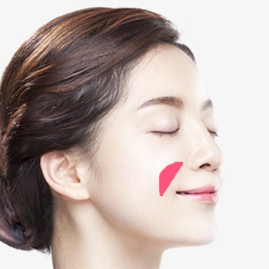 Para nasal implant contouring surgery.