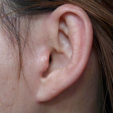 Faded Korean facelift scar 6 months after surgery.
