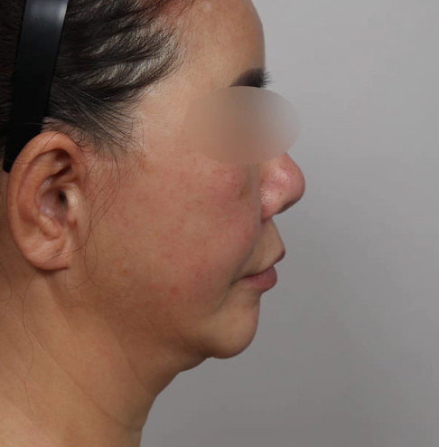Korean neck lift before photo highlighting double chin and visible skin laxity under the neck.