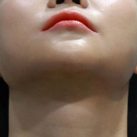 Not visible Korean double chin and Korean neck lift surgery incision 6 months later.