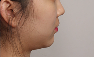 Turkey case double chin 1.