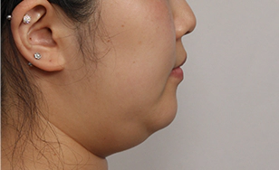 Turkey case double chin 4.