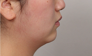 Short chin with korean double chin.