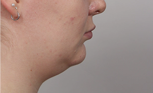 Side profile of female patient before procedure showing sagging jawline and undefined Korean double chin.