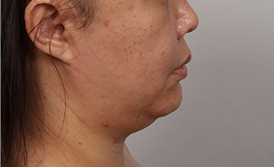 Toad case double chin before surgery 3.