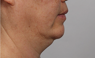 Turkey case double chin 3.