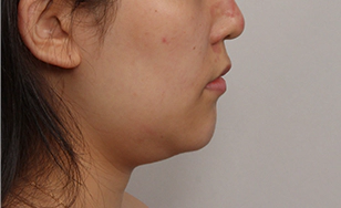Toad case double chin before surgery 4.