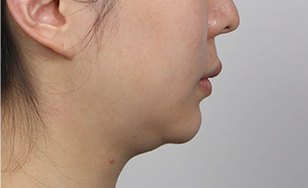 Turkey case double chin 5.