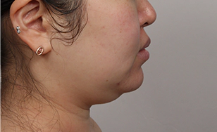 Toad case double chin before surgery 5.