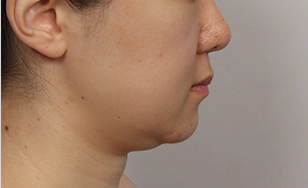 Toad case double chin before surgery 6.