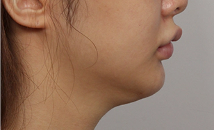 Indistinct boundary between the chin and the neck.