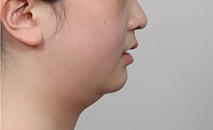 Sagging short double chin.