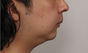 Short chin and sagging double chin.