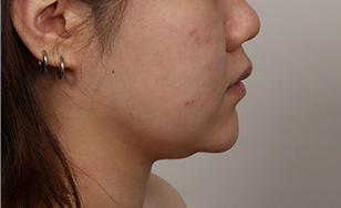 Side view before correction showing korean double chin and recessed chin profile.
