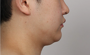 Toad case Korean double chin before surgery 1.