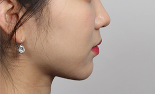 Korean double chin after 2 months with slimmer neck profile and sharper jawline contour.