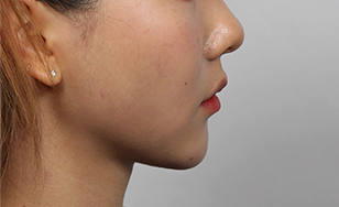 Profile view after 2 months highlighting sharper jawline and significant Korean double chin reduction.